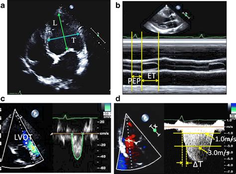 lv sphericity index formula|echocardiogram for sphericity index.